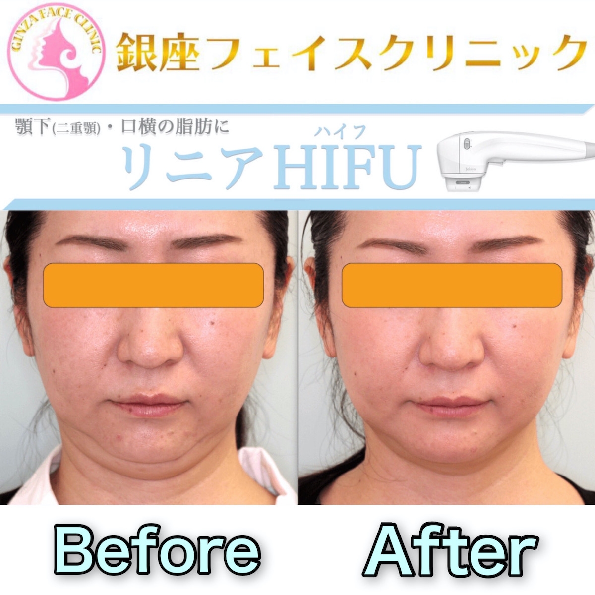 症例写真 リニアhifu 顎下 口横 小顔整形 輪郭整形専門の美容外科 銀座フェイスクリニック 症例写真 リニアhifu 顎下 口横 小顔整形 輪郭整形専門の美容外科 銀座フェイスクリニック