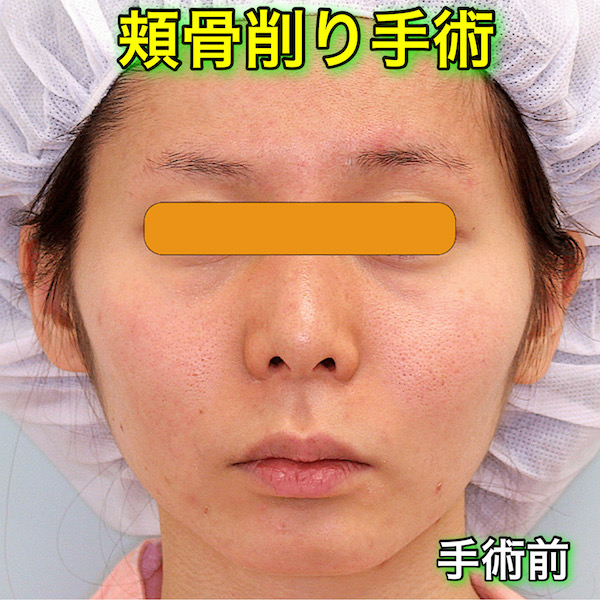 頬骨削り手術の症例写真（BeforeAfter）