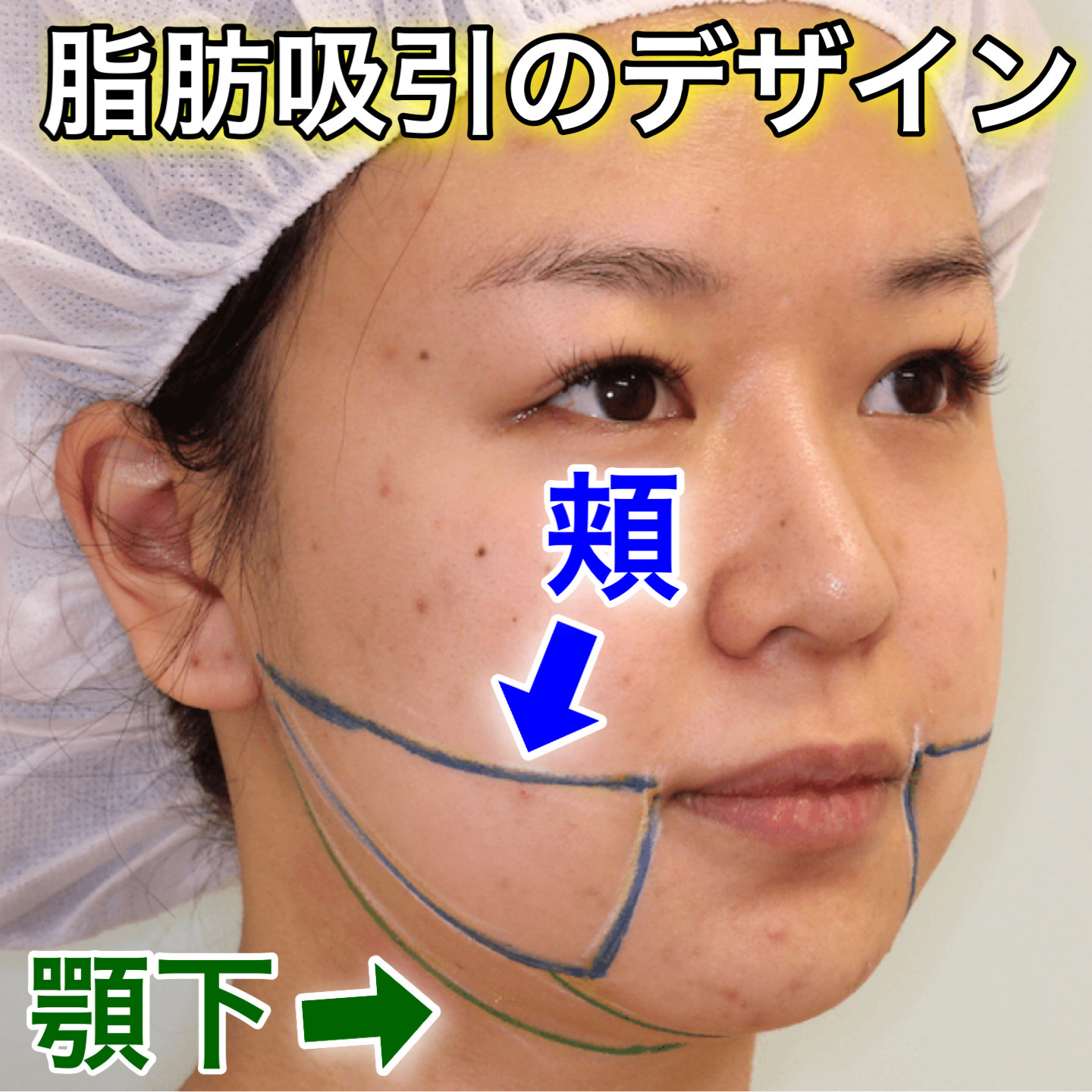 頬と顎下の脂肪吸引・バッカルファット除去・HIFUリフトの症例写真