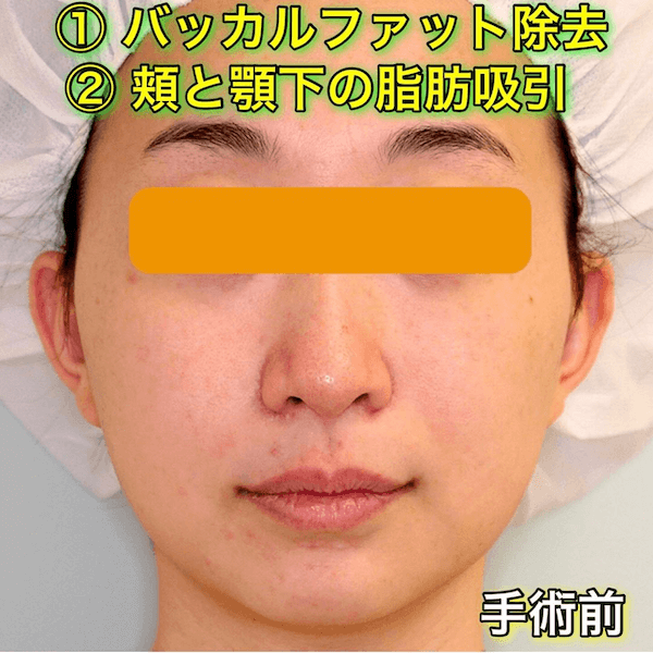 バッカルファット除去｜頬と顎下の脂肪吸引