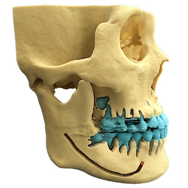3D骨格模型｜骨切り・骨削り手術の術前検査