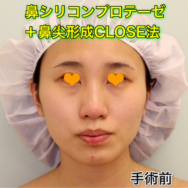 鼻プロテーゼ＋鼻尖形成CLOSE法