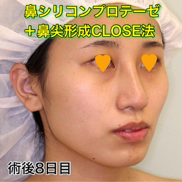 鼻プロテーゼ＋鼻尖形成CLOSE法