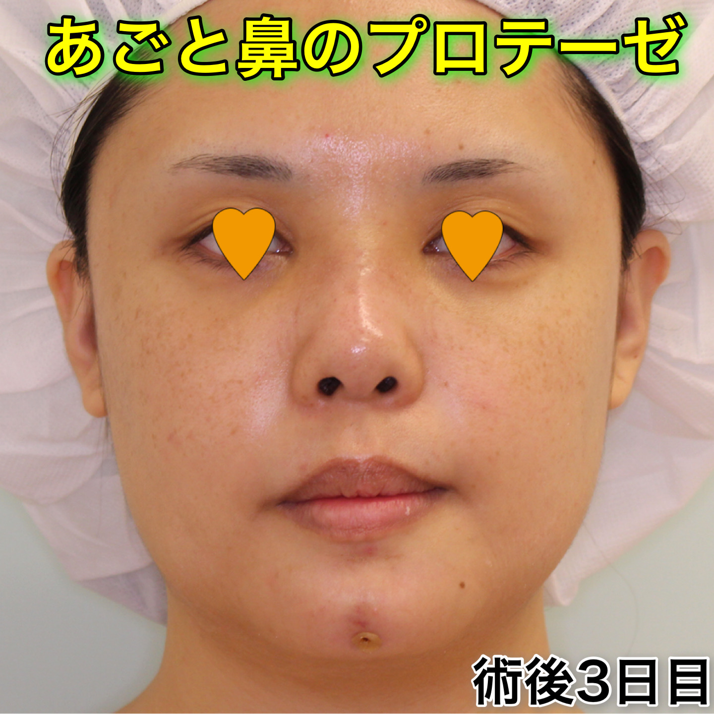 鼻プロテーゼ＋顎プロテーゼのビフォーアフター（症例写真）