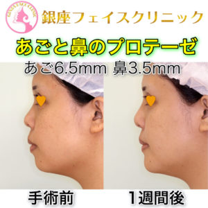 鼻プロテーゼ＋顎プロテーゼのビフォーアフター（症例写真）