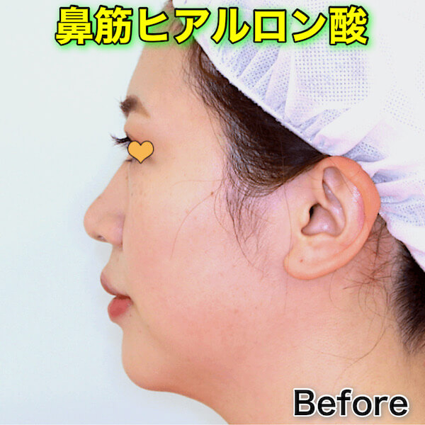 鼻筋ヒアルロン酸のビフォーアフター（症例写真）｜ボリューマXC