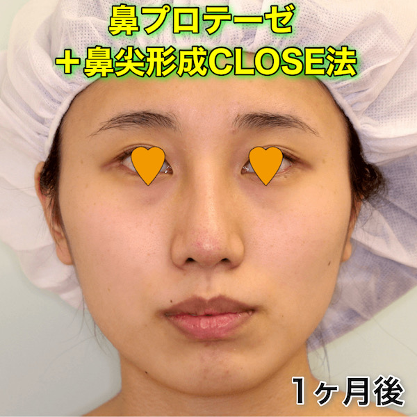 鼻プロテーゼ＋鼻尖形成CLOSE法の症例写真（ビフォーアフター）
