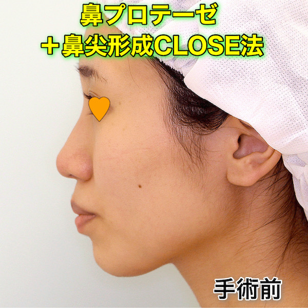 鼻プロテーゼ＋鼻尖形成CLOSE法の症例写真（ビフォーアフター）