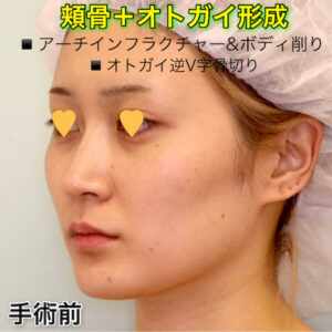 頬骨削り（アーチインフラクチャー＆ボディ削り）+オトガイ形成（逆V字骨切り）の症例写真ビフォーアフター（Before After）