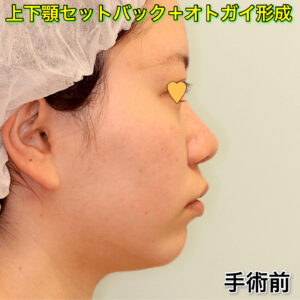 上下顎セットバック+オトガイ形成の症例写真（ビフォーアフター）