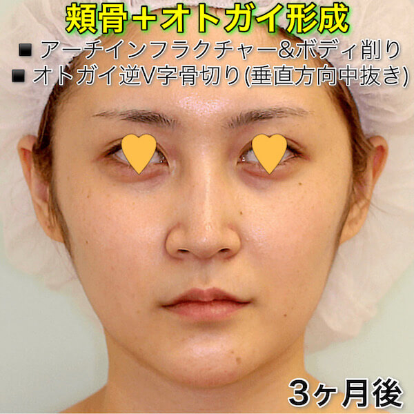 頬骨削り（アーチインフラクチャー＆ボディ削り）+オトガイ形成（逆V字骨切り）の症例写真ビフォーアフター（Before After）