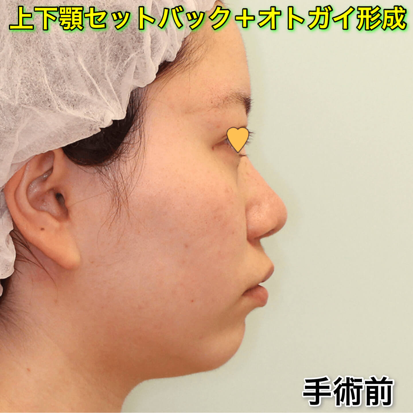 上下顎セットバック+オトガイ形成の症例写真（ビフォーアフター）