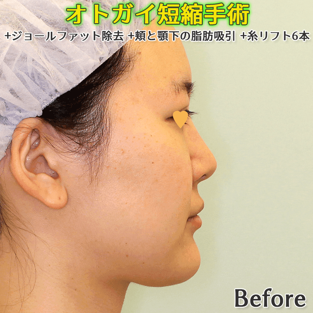オトガイ形成（逆V字骨切り/中抜きによる短縮手術）+ジョールファット除去+頬と顎下の脂肪吸引+糸リフト6本