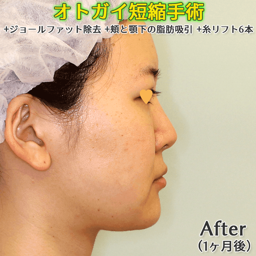 オトガイ形成（逆V字骨切り/中抜きによる短縮手術）+ジョールファット除去+頬と顎下の脂肪吸引+糸リフト6本