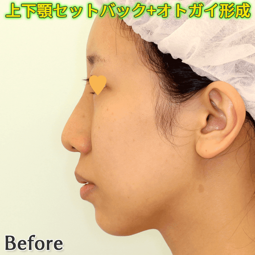 上下顎セットバック+オトガイ形成のビフォーアフター症例写真（ゴボ口・口ゴボ・突出口の改善）