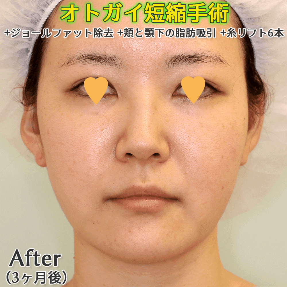 オトガイ形成（オトガイ短縮）+ジョールファット除去+頬と顎下の脂肪吸引+糸リフトのビフォーアフタ〜症例写真