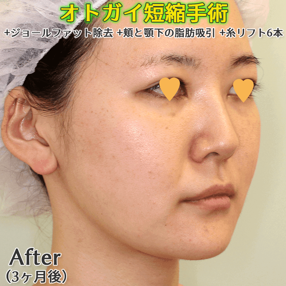 オトガイ形成（オトガイ短縮）+ジョールファット除去+頬と顎下の脂肪吸引+糸リフトのビフォーアフタ〜症例写真