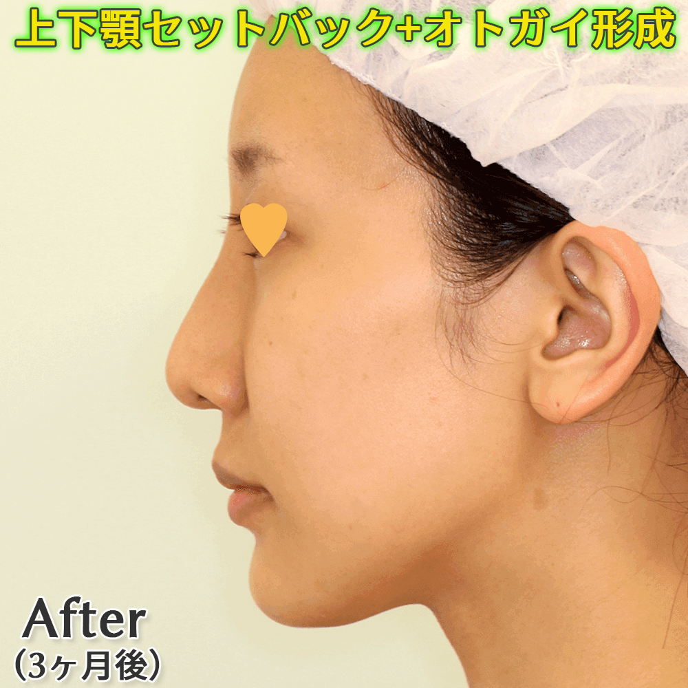 上下顎セットバック+オトガイ形成のビフォーアフター症例写真（ゴボ口・口ゴボ・突出口の改善）