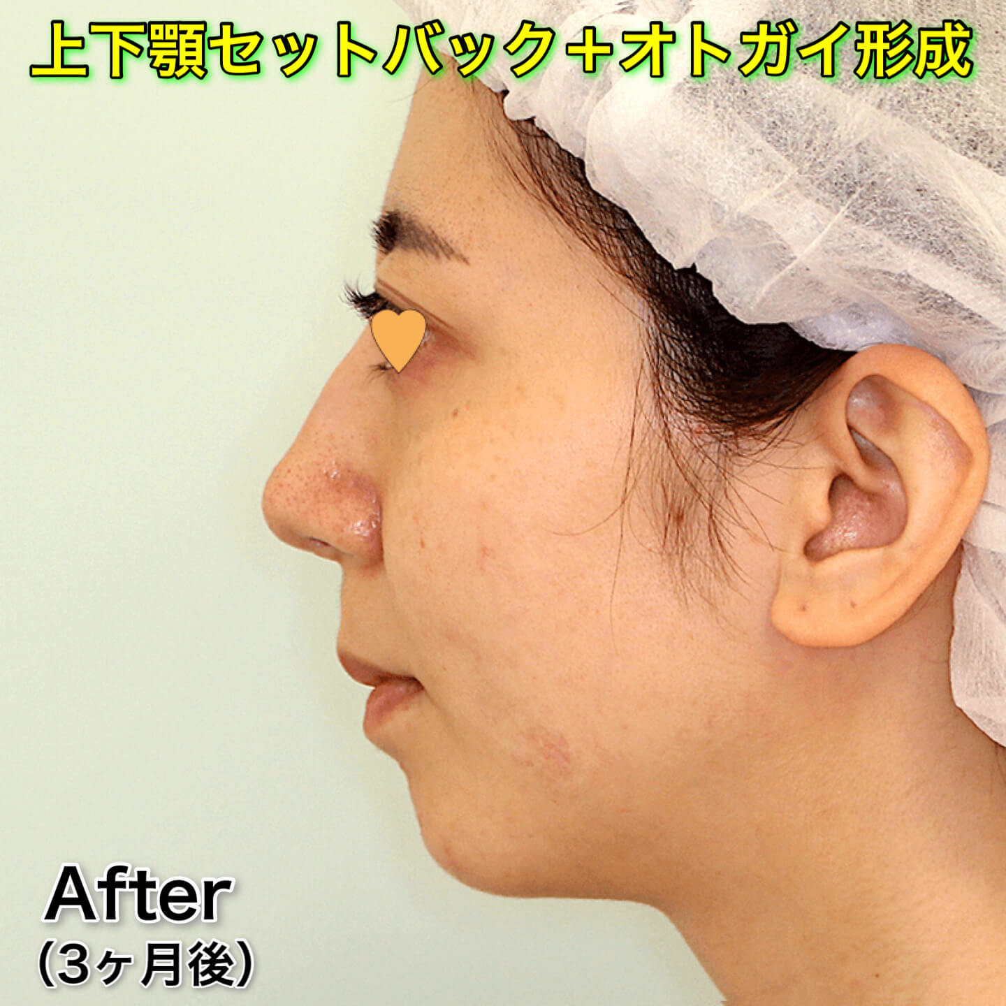 上下顎セットバック+オトガイ形成+ジョールファット除去+顎下脂肪吸引+糸リフトの症例写真（ビフォーアフター）