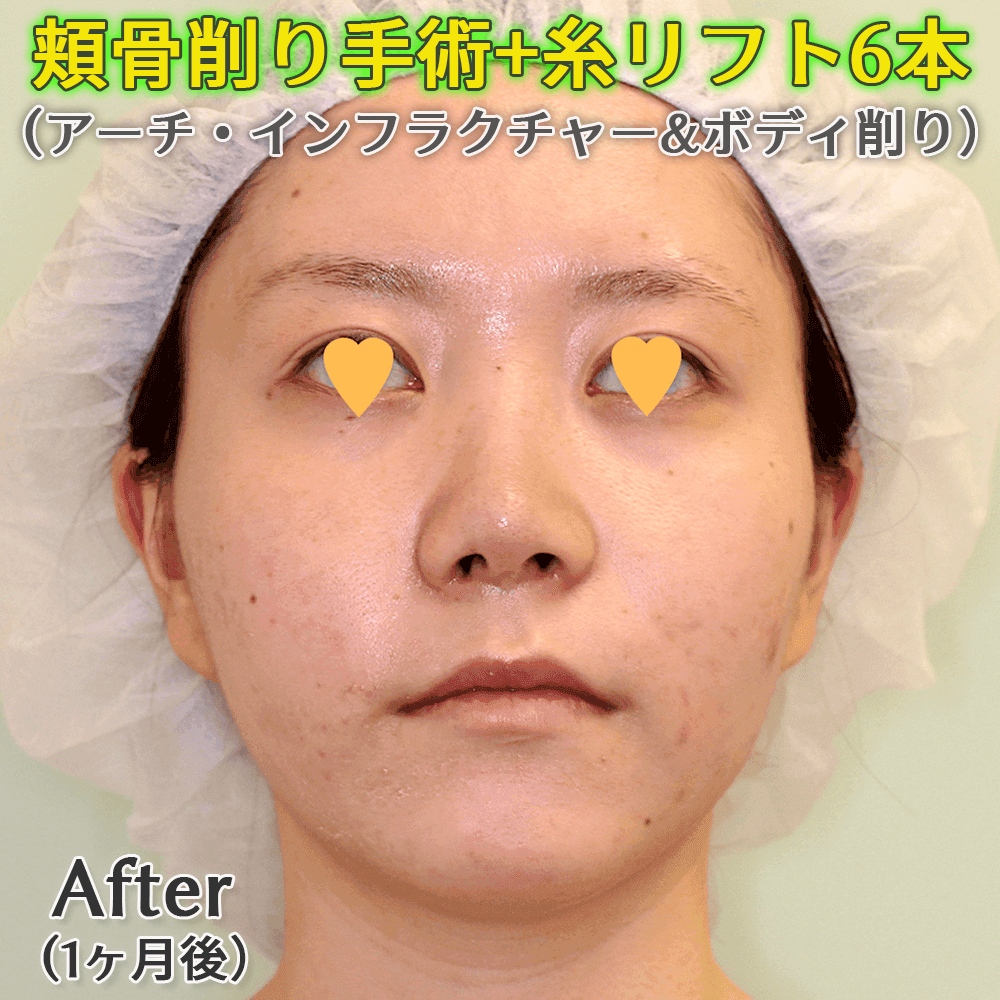 頬骨削り（アーチ・インフラクチャー+ボディ削り）のビフォーアフター症例写真