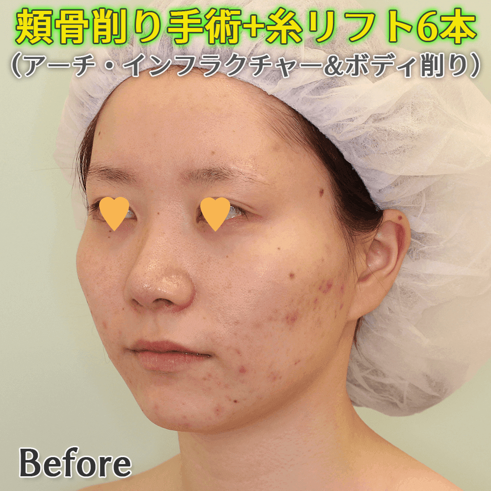 頬骨削り（アーチ・インフラクチャー+ボディ削り）のビフォーアフター症例写真