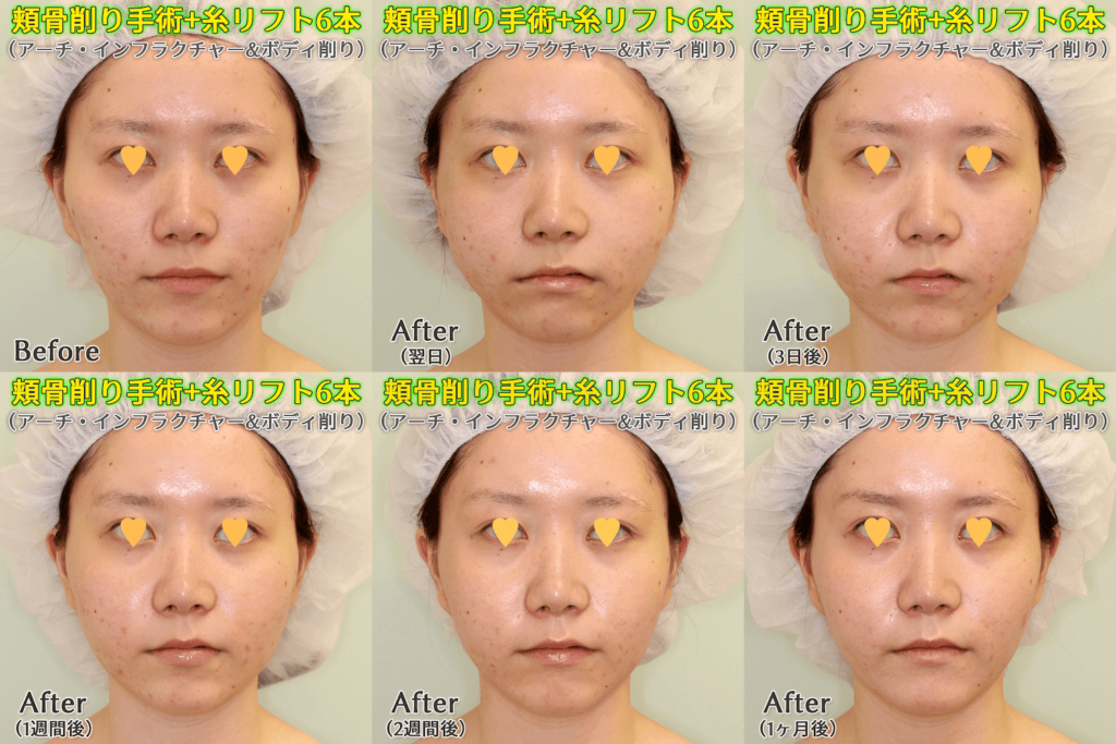 頬骨削り（アーチ・インフラクチャー+ボディ削り）のビフォーアフター症例写真｜ダウンタイム