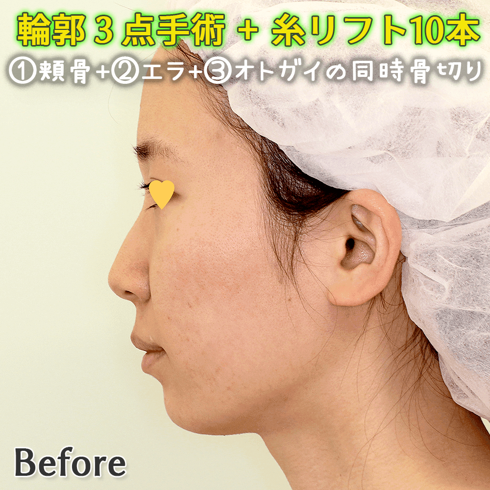 輪郭三点手術（頬骨・エラ・オトガイの同時骨切り・骨削り）ビフォーアフター症例写真