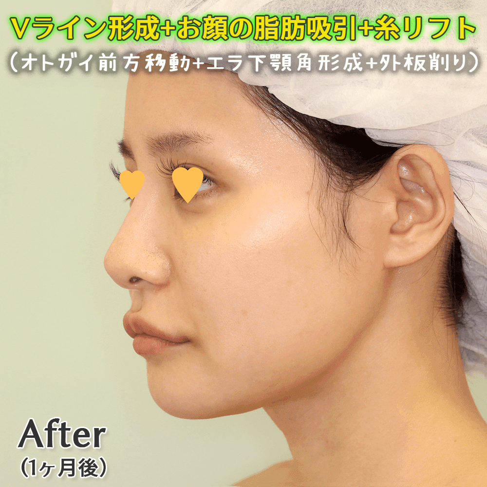 Vライン形成（オトガイ前方移動+エラ下顎角形成+外板削り）+お顔の脂肪吸引4部位+糸リフトのビフォーアフター症例写真