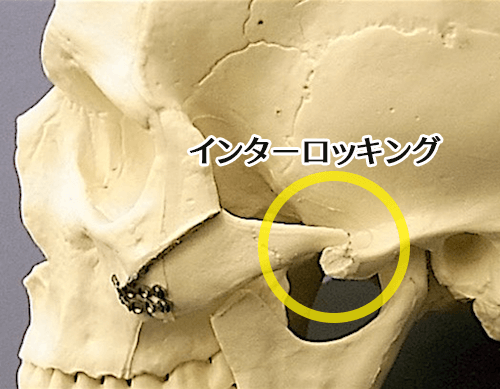 頬骨弓の側方固定|インターロッキング