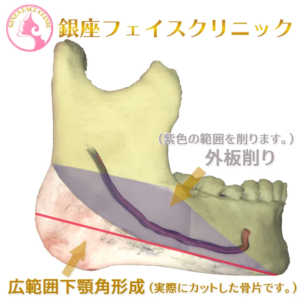 エラ骨切り手術|回し切りと直線切り