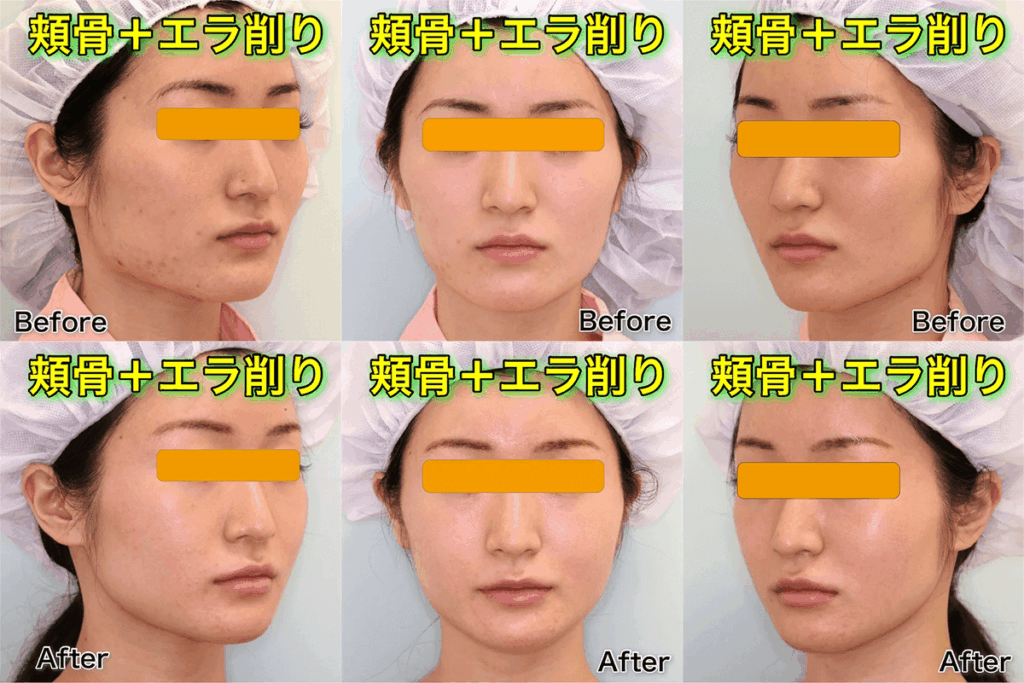 輪郭2点手術(頬骨+エラ)のビフォーアフター症例写真|1年3ヶ月後の長期経過