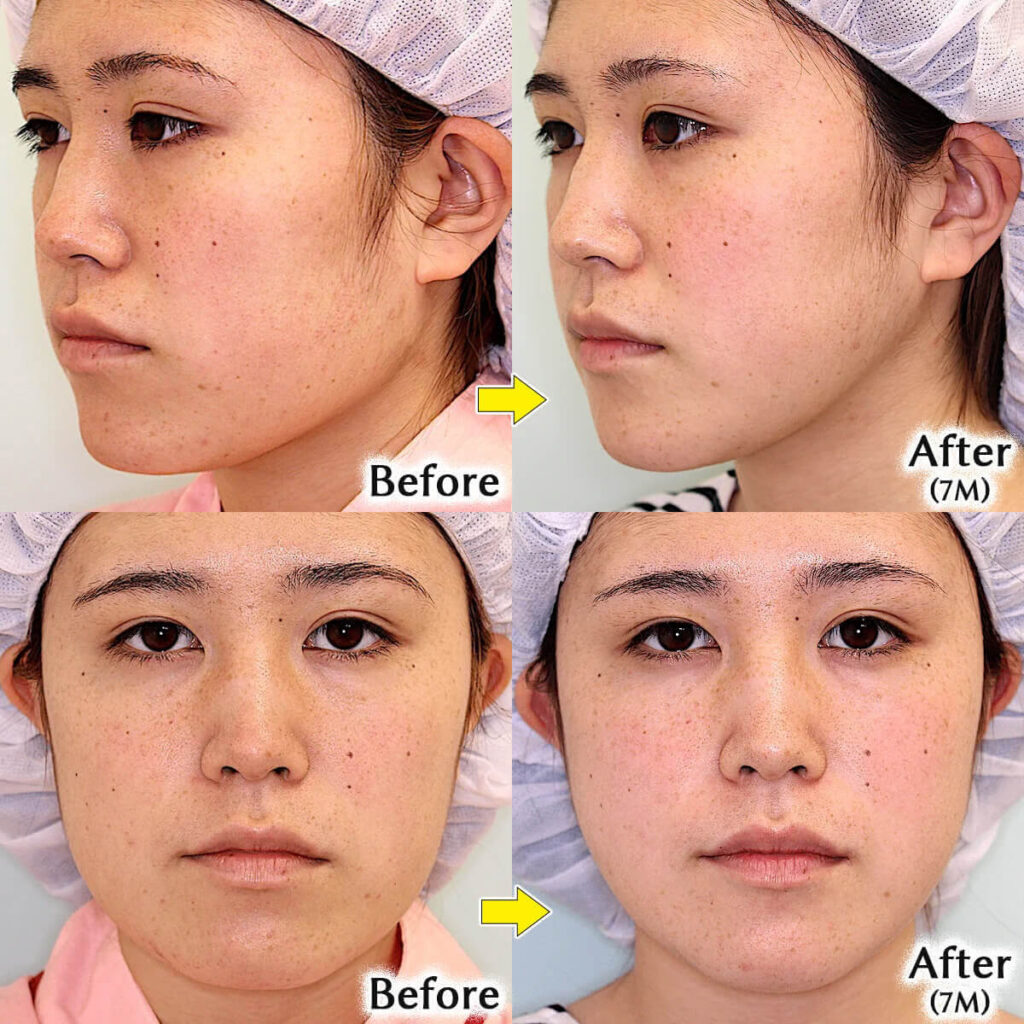 エラ削りのビフォーアフター症例写真