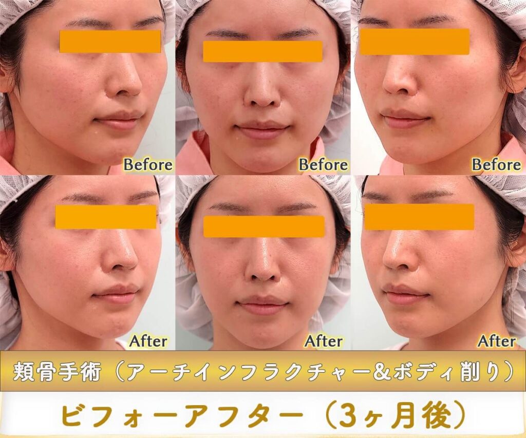 頬骨骨切り手術(アーチインフラクチャー&ボディ削り)のビフォーアフター症例写真