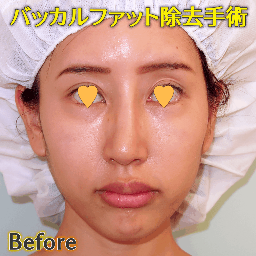 バッカルファット除去手術のビフォーアフター症例写真