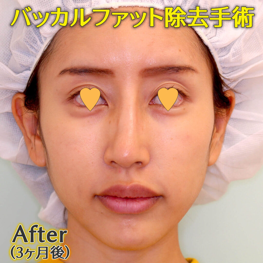 バッカルファット除去手術のビフォーアフター症例写真