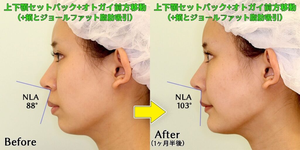 上下顎セットバックによる鼻唇角(NLA)の変化|ビフォーアフター症例写真