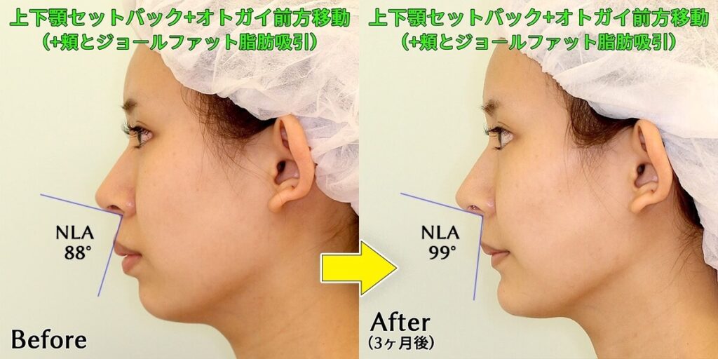 上下顎セットバックによる鼻唇角(NLAの変化)