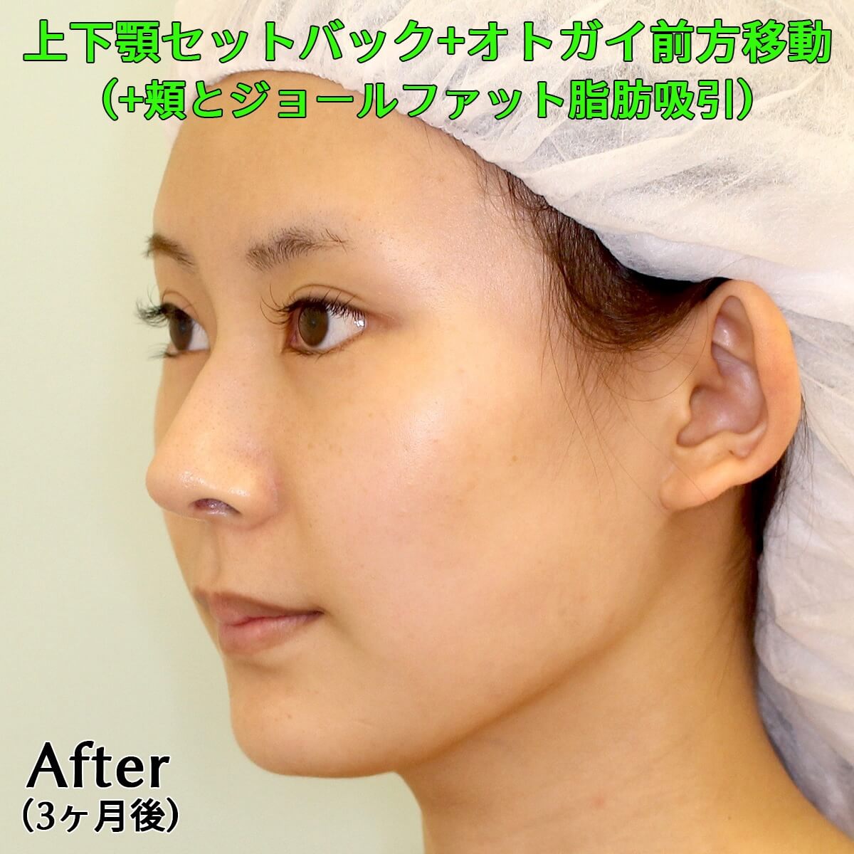上下顎セットバック+オトガイ前方移動のビフォーアフター症例写真(3ヶ月後)|銀座フェイスクリニック奥田院長執刀