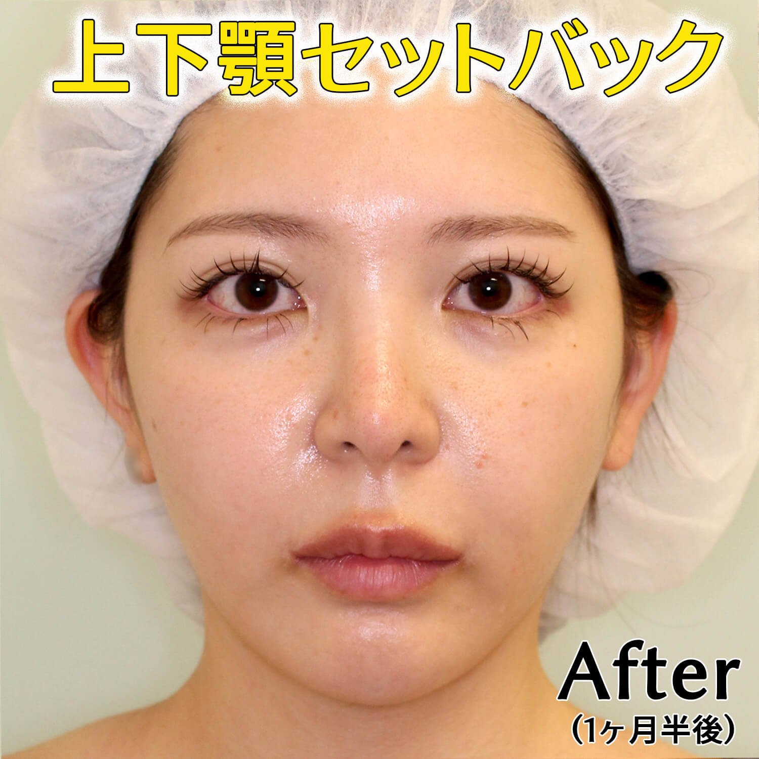 上下顎セットバックのビフォーアフター症例写真(1ヶ月半後)